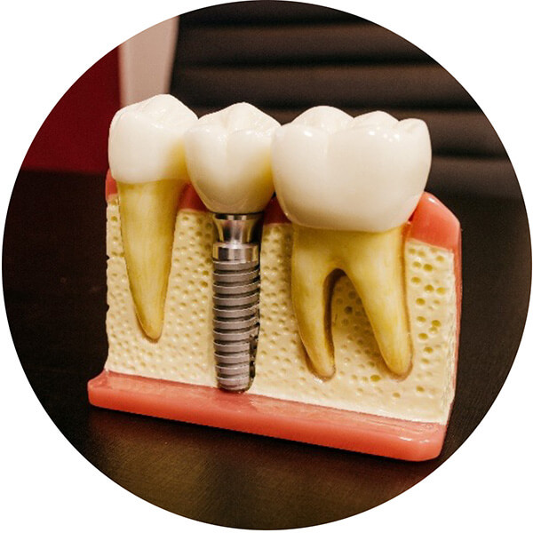 Dental Implant Display